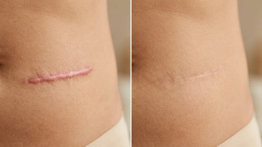 Scar Removal Before and After: Realistic Expectations by Type - Image 1