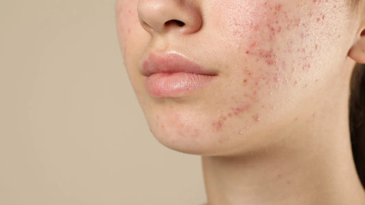 acne scar