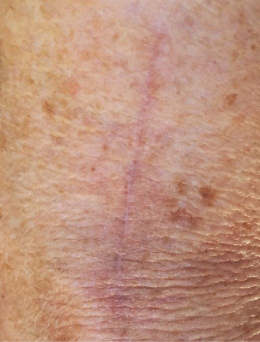 Scar After 1 Month of Biocornem
