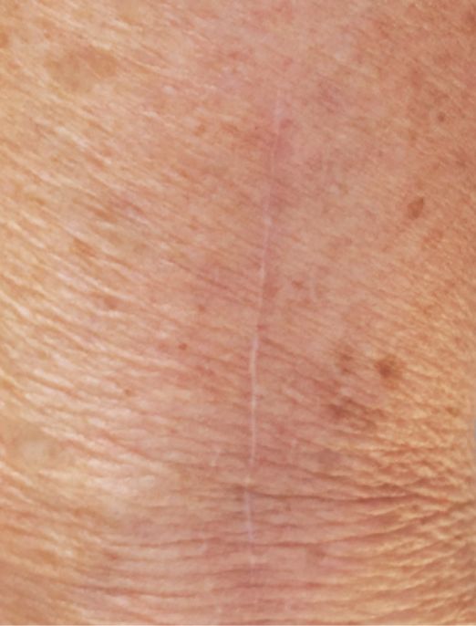 Scar After 3 Months of Biocornem