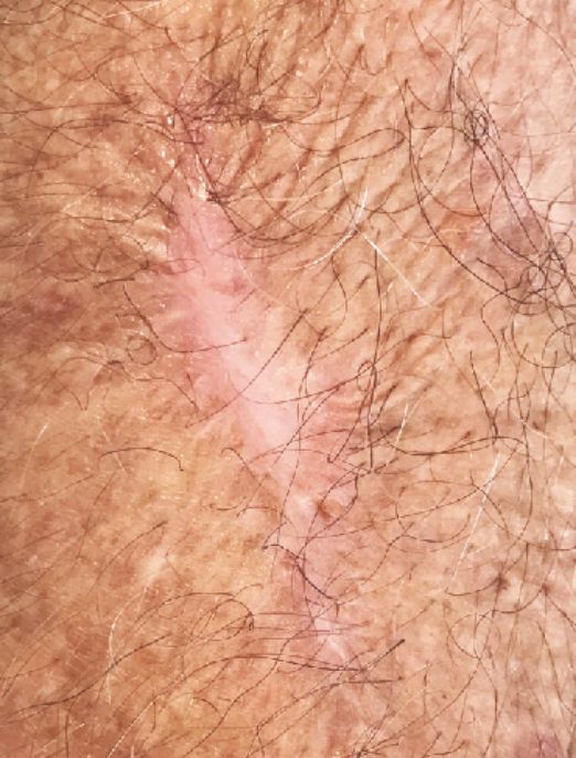 Scar After 10 Weeks of Biocornem